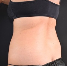 Liposuction Before Photo by Sean Doherty, MD; Chestnut Hill, MA - Case 50048