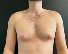 Male Breast Reduction Before Photo by Sean Doherty, MD; Chestnut Hill, MA - Case 50045 Male Breast Reduction Before Photo by Sean Doherty, MD; Chestnut Hill, MA - Case 50045