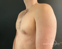 Male Breast Reduction After Photo by Sean Doherty, MD; Chestnut Hill, MA - Case 50045