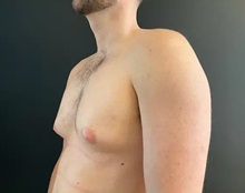 Male Breast Reduction Before Photo by Sean Doherty, MD; Chestnut Hill, MA - Case 50045