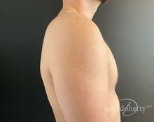 Male Breast Reduction After Photo by Sean Doherty, MD; Chestnut Hill, MA - Case 50045