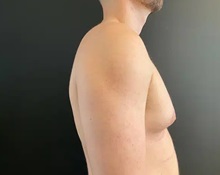 Male Breast Reduction Before Photo by Sean Doherty, MD; Chestnut Hill, MA - Case 50045