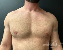 Male Breast Reduction After Photo by Sean Doherty, MD; Chestnut Hill, MA - Case 50044 Male Breast Reduction After Photo by Sean Doherty, MD; Chestnut Hill, MA - Case 50044