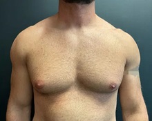 Male Breast Reduction Before Photo by Sean Doherty, MD; Chestnut Hill, MA - Case 50044 Male Breast Reduction Before Photo by Sean Doherty, MD; Chestnut Hill, MA - Case 50044
