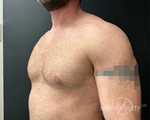 Male Breast Reduction After Photo by Sean Doherty, MD; Chestnut Hill, MA - Case 50044