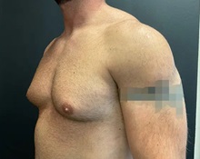 Male Breast Reduction Before Photo by Sean Doherty, MD; Chestnut Hill, MA - Case 50044