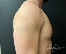 Male Breast Reduction After Photo by Sean Doherty, MD; Chestnut Hill, MA - Case 50044