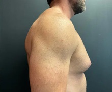 Male Breast Reduction Before Photo by Sean Doherty, MD; Chestnut Hill, MA - Case 50044