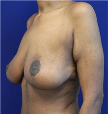 Breast Lift After Photo by Jason Cooper, MD; Jupiter, FL - Case 31213