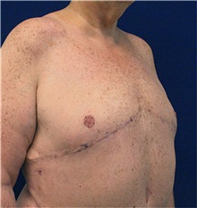 Male Breast Reduction After Photo by Jason Cooper, MD; Jupiter, FL - Case 31217