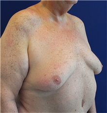 Male Breast Reduction Before Photo by Jason Cooper, MD; Jupiter, FL - Case 31217