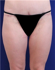 Thigh Lift After Photo by Jason Cooper, MD; Jupiter, FL - Case 31220