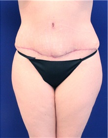 Tummy Tuck After Photo by Jason Cooper, MD; Jupiter, FL - Case 31223