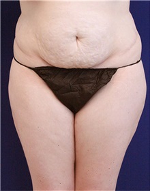 Tummy Tuck Before Photo by Jason Cooper, MD; Jupiter, FL - Case 31223