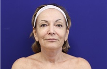 Neck Lift After Photo by Jason Cooper, MD; Jupiter, FL - Case 38019