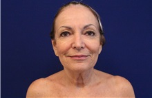 Neck Lift Before Photo by Jason Cooper, MD; Jupiter, FL - Case 38019