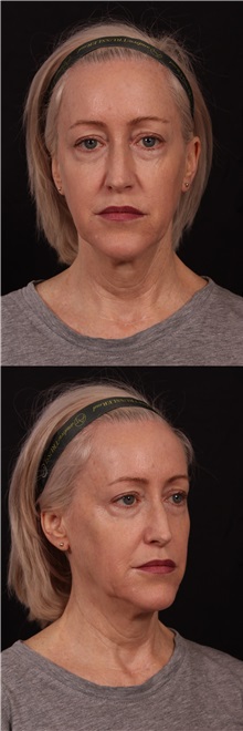 Neck Lift Before Photo by Andrew Trussler, MD FACS; Austin, TX - Case 37096