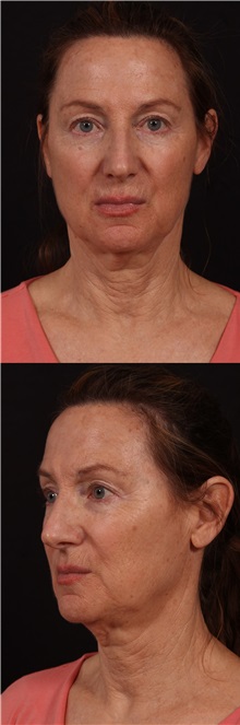 Neck Lift Before Photo by Andrew Trussler, MD FACS; Austin, TX - Case 37101