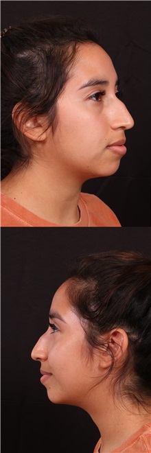 Rhinoplasty Before Photo by Andrew Trussler, MD FACS; Austin, TX - Case 37109