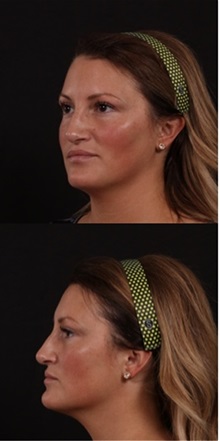 Rhinoplasty After Photo by Andrew Trussler, MD FACS; Austin, TX - Case 37111