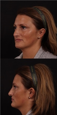 Rhinoplasty Before Photo by Andrew Trussler, MD FACS; Austin, TX - Case 37111