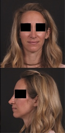 Rhinoplasty After Photo by Andrew Trussler, MD FACS; Austin, TX - Case 37117