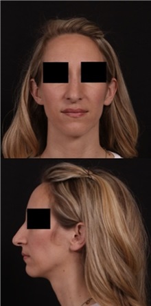 Rhinoplasty Before Photo by Andrew Trussler, MD FACS; Austin, TX - Case 37117