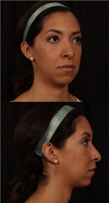 Rhinoplasty Before Photo by Andrew Trussler, MD FACS; Austin, TX - Case 37118