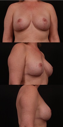Breast Lift After Photo by Andrew Trussler, MD FACS; Austin, TX - Case 37140