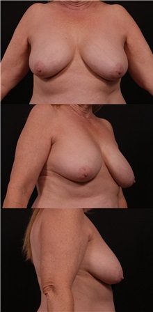 Breast Lift Before Photo by Andrew Trussler, MD FACS; Austin, TX - Case 37143