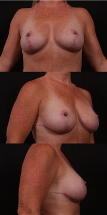 Breast Lift After Photo by Andrew Trussler, MD FACS; Austin, TX - Case 37150