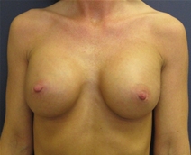 Breast Augmentation After Photo by Pramit Malhotra, MD; Ann Arbor, MI - Case 23329
