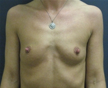 Breast Augmentation Before Photo by Pramit Malhotra, MD; Ann Arbor, MI - Case 23329