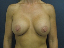 Breast Augmentation After Photo by Pramit Malhotra, MD; Ann Arbor, MI - Case 23331
