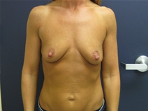 Breast Augmentation Before Photo by Pramit Malhotra, MD; Ann Arbor, MI - Case 23331