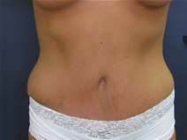 Tummy Tuck After Photo by Pramit Malhotra, MD; Ann Arbor, MI - Case 23333