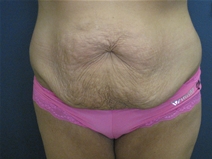Tummy Tuck Before Photo by Pramit Malhotra, MD; Ann Arbor, MI - Case 23333