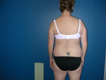 Liposuction Before Photo by Pramit Malhotra, MD; Ann Arbor, MI - Case 23335