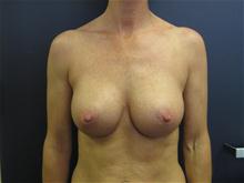 Breast Augmentation After Photo by Pramit Malhotra, MD; Ann Arbor, MI - Case 25926