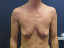 Breast Augmentation Before Photo by Pramit Malhotra, MD; Ann Arbor, MI - Case 25926