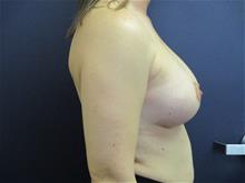 Breast Augmentation After Photo by Pramit Malhotra, MD; Ann Arbor, MI - Case 29861