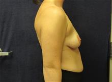Breast Augmentation Before Photo by Pramit Malhotra, MD; Ann Arbor, MI - Case 29861