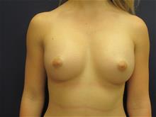 Breast Augmentation After Photo by Pramit Malhotra, MD; Ann Arbor, MI - Case 29863