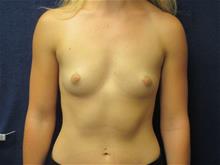 Breast Augmentation Before Photo by Pramit Malhotra, MD; Ann Arbor, MI - Case 29863