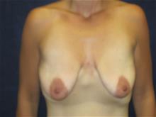 Breast Augmentation Before Photo by Pramit Malhotra, MD; Ann Arbor, MI - Case 29864