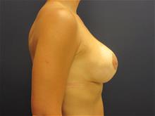 Breast Augmentation After Photo by Pramit Malhotra, MD; Ann Arbor, MI - Case 29864