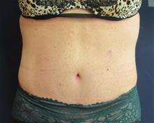 Tummy Tuck After Photo by Pramit Malhotra, MD; Ann Arbor, MI - Case 29868