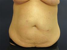 Tummy Tuck Before Photo by Pramit Malhotra, MD; Ann Arbor, MI - Case 29868