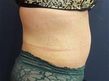 Tummy Tuck After Photo by Pramit Malhotra, MD; Ann Arbor, MI - Case 29868