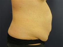Tummy Tuck Before Photo by Pramit Malhotra, MD; Ann Arbor, MI - Case 29868